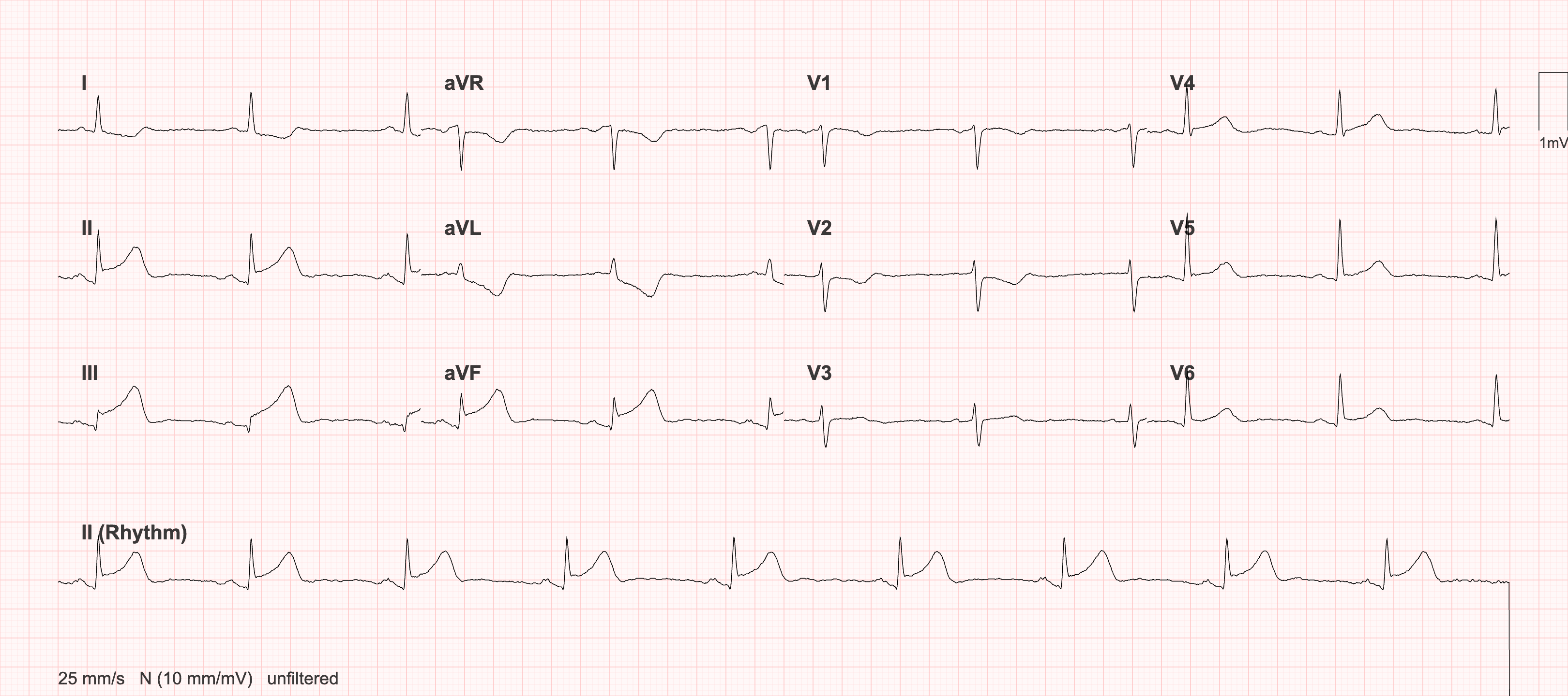 12-lead EKG of the demo patient